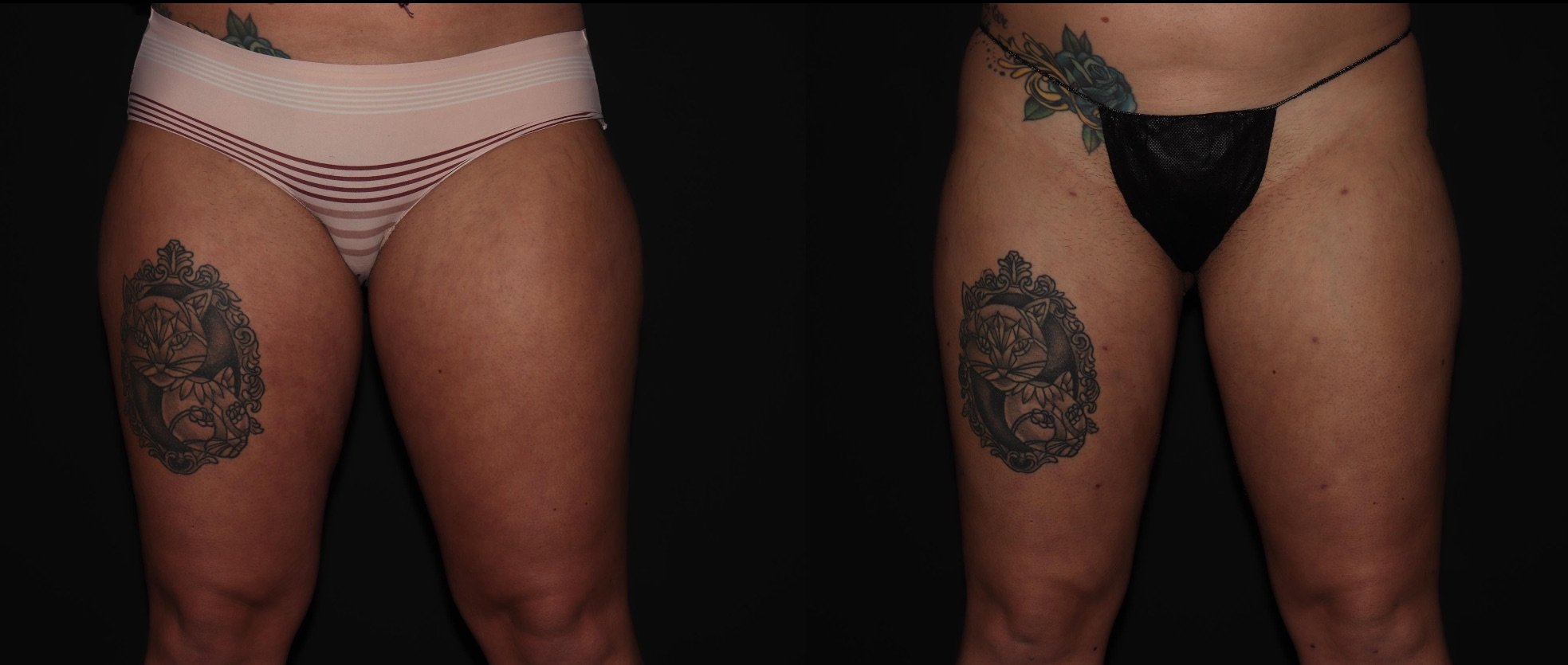 Before and After Image: Liposuction – Thighs - front